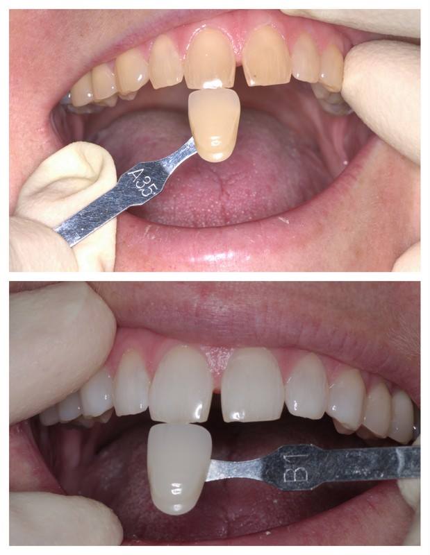 cosmetic-dentistry-tooth-whitening-page-pdf