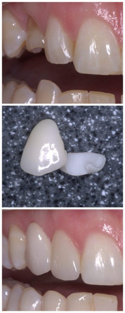 treatments-cosmetic-dentistry-porcelain-ceramic-and-precious-metal1
